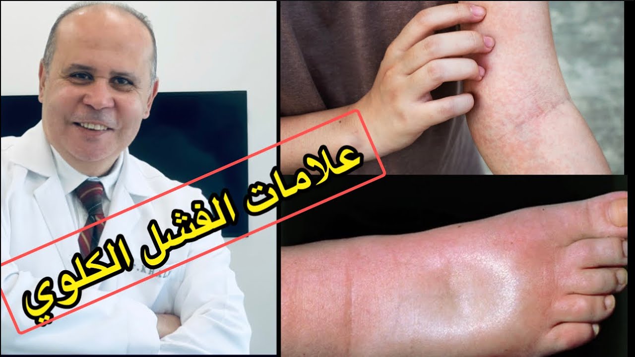 ١٠علامات في جسمك تخبرك بوجود 👈👈فشل في وظايف الكلي