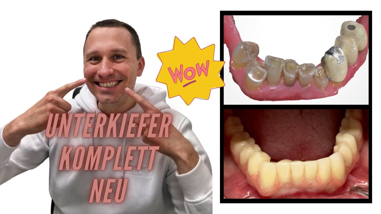 Das war besonders! Unterkiefer mit Teleskop-Brücke komplett neu 🤩 | Zahnarzt Dr. Maximilian Fuhrmann