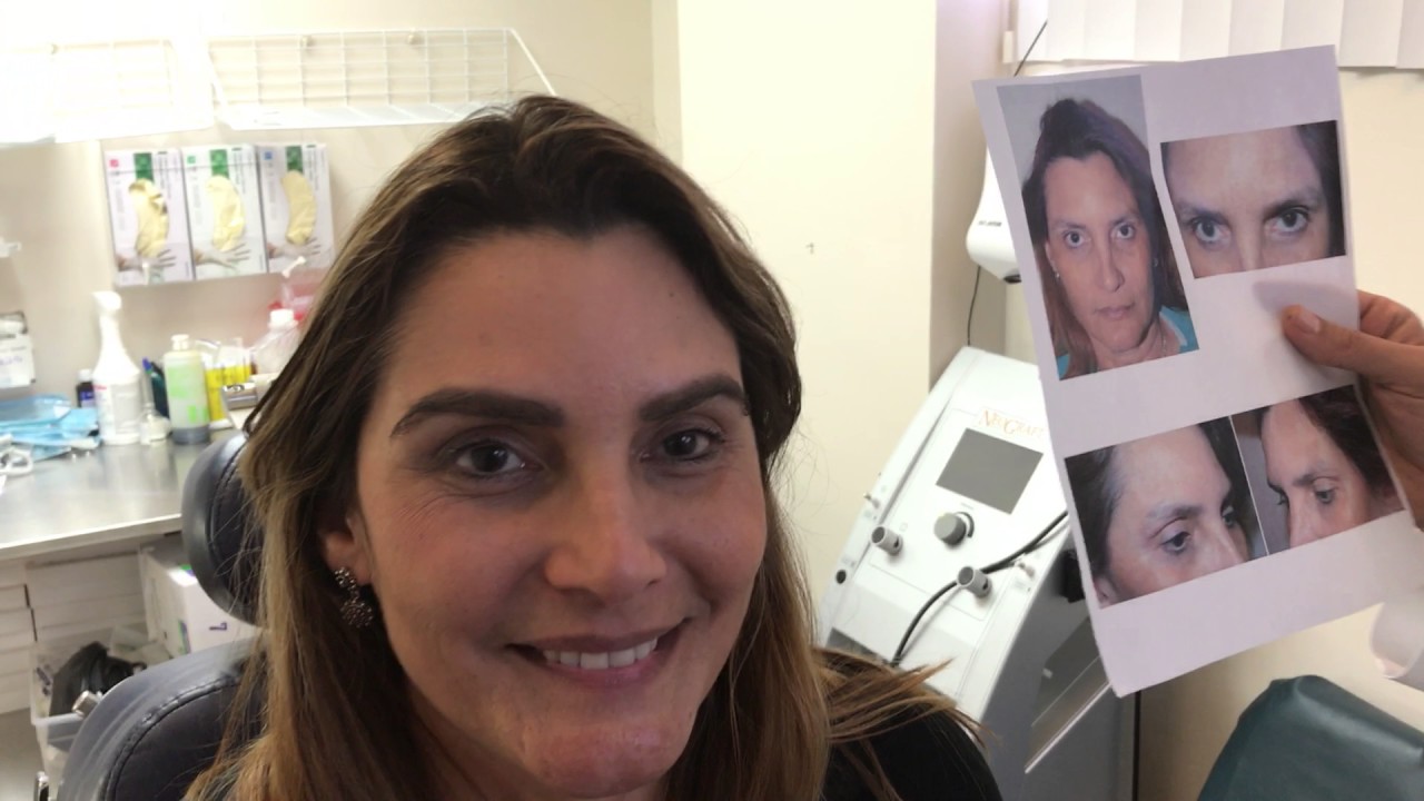 Eyebrow Transplant Result at 7 months- Patient of Dr. Epstein.