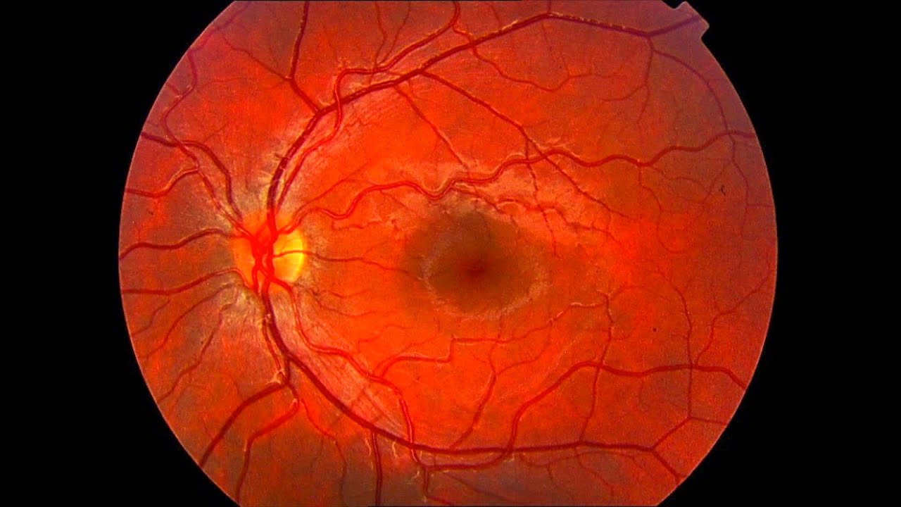 El retinografo (angiógrafo) - Centro de Oftalmología Bonafonte