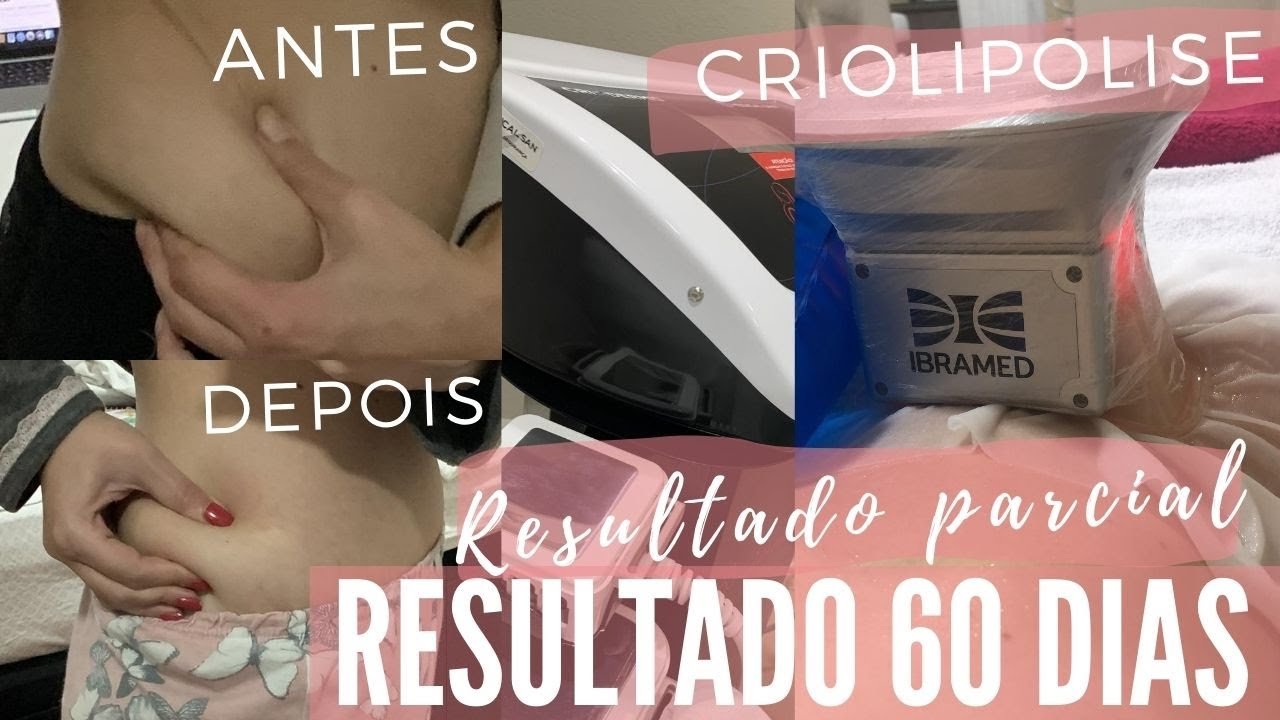 RESULTADO CRIOLIPOLISE FLANCOS -  Bruna Harmel