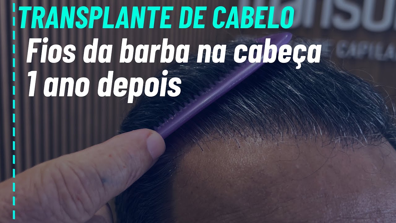 Cabelo da barba na cabeça no transplante capilar