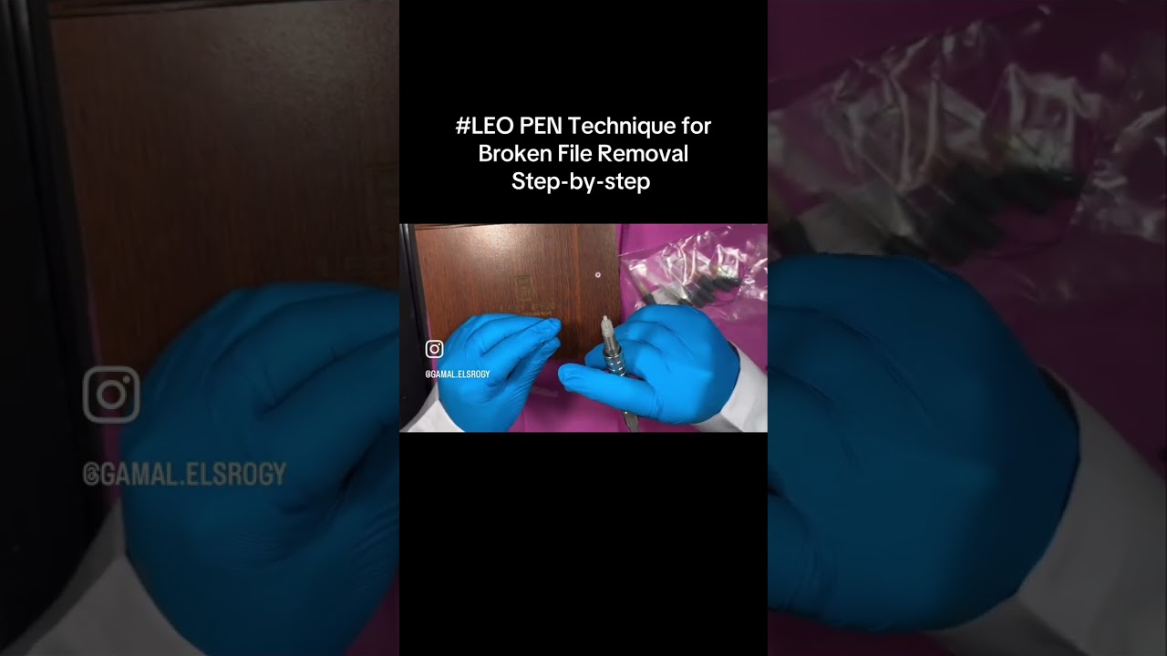 LEO PEN Technique for Broken File Removal Step-by-step explanation