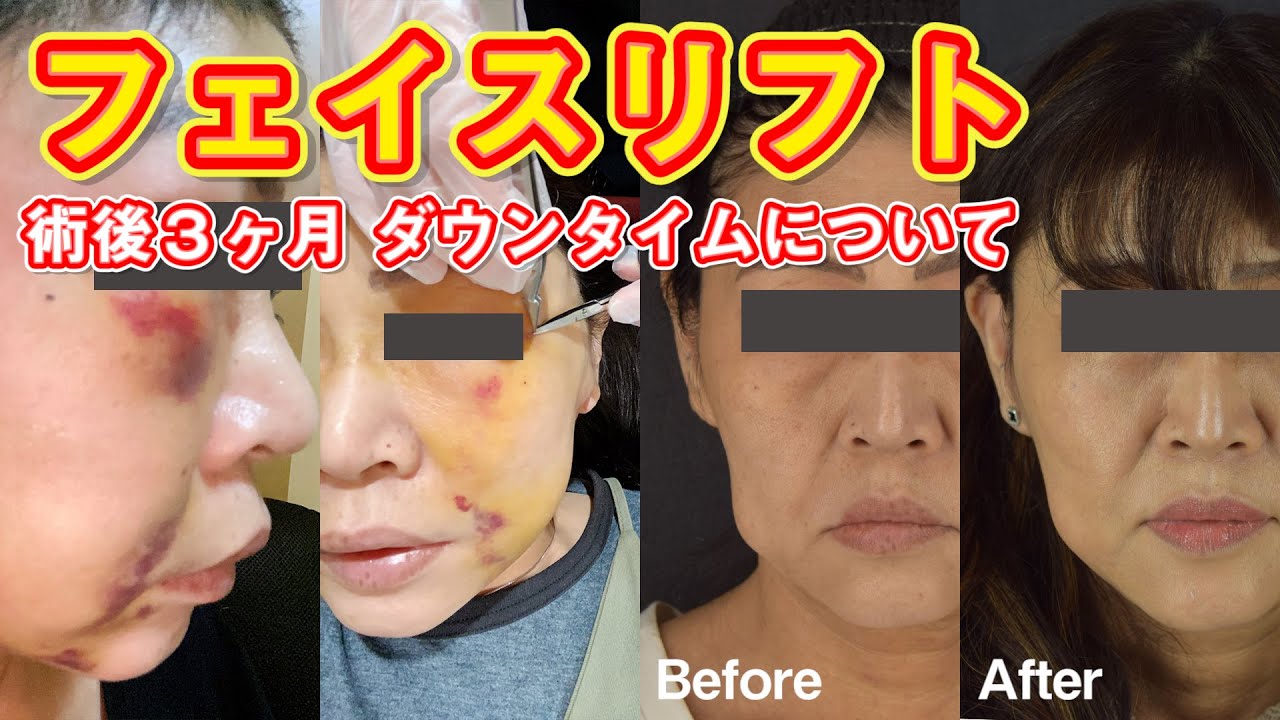 【切開フェイスリフト】ダウンタイムの様子や受けた感想について患者様にインタビュー【ドラゴン細井】