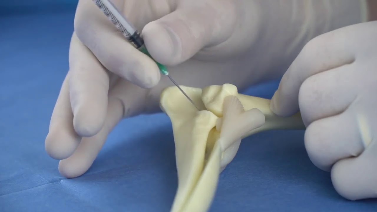 Elbow Injection Enso Discoveries