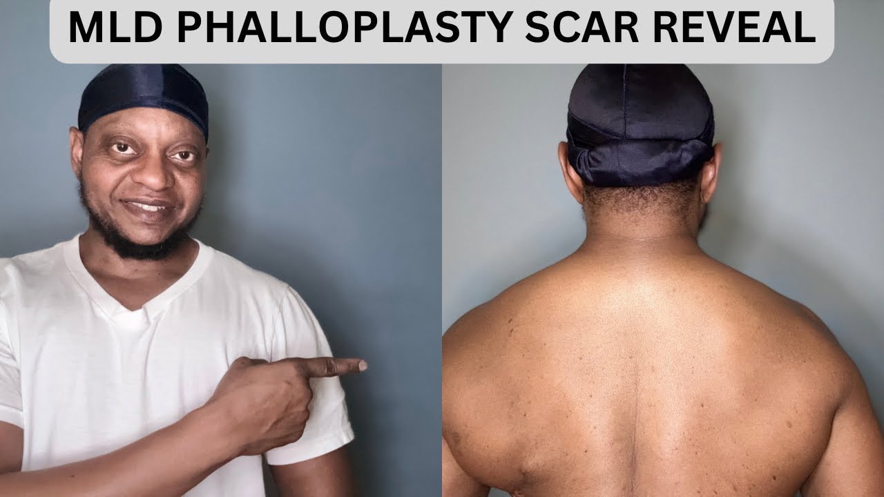MLD PHALLOPLASTY SCAR REVEAL PT. 2/TRANSparent Tuesday #transman #phalloplasty #ftm #mldphalloplasty