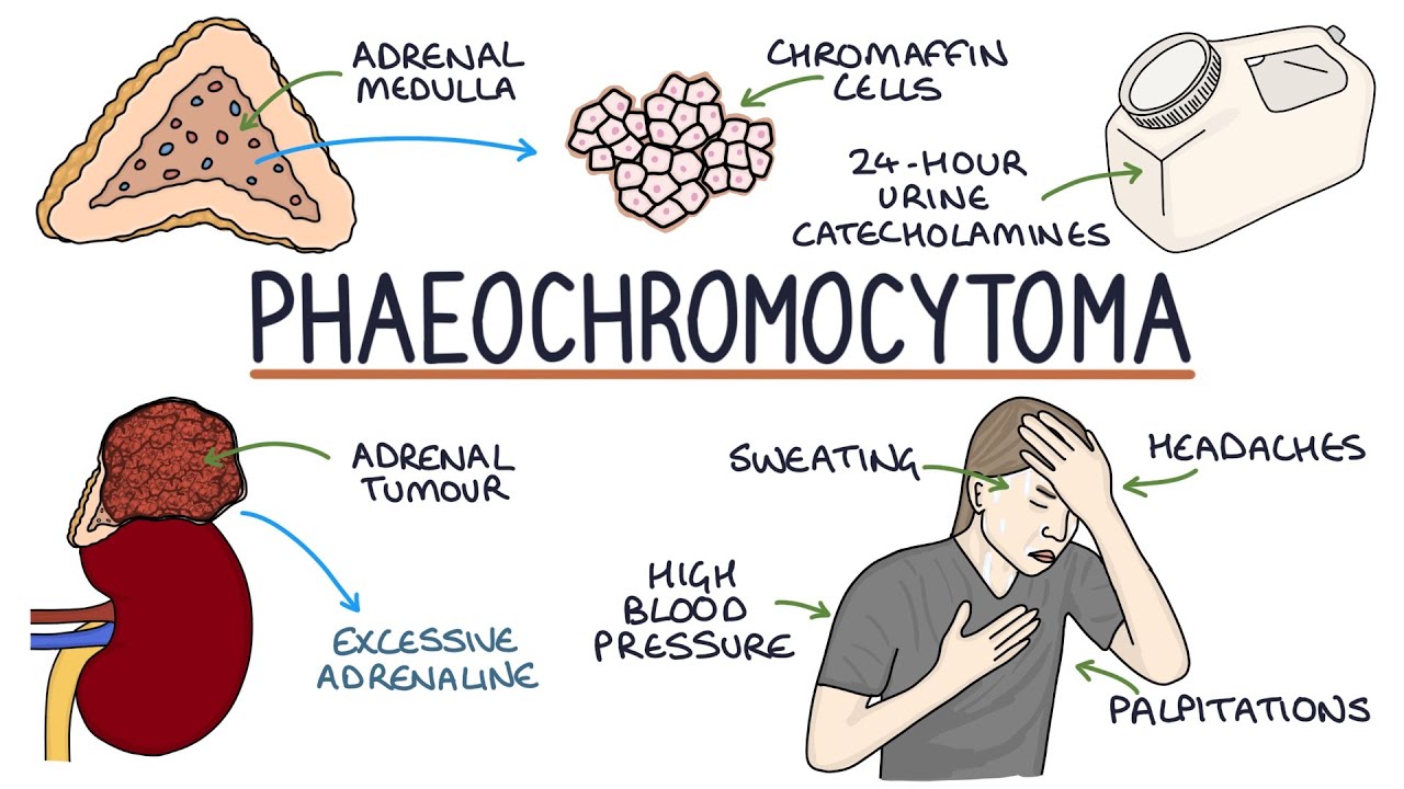 Phaeochromocytoma - A Visual Explanation For Students