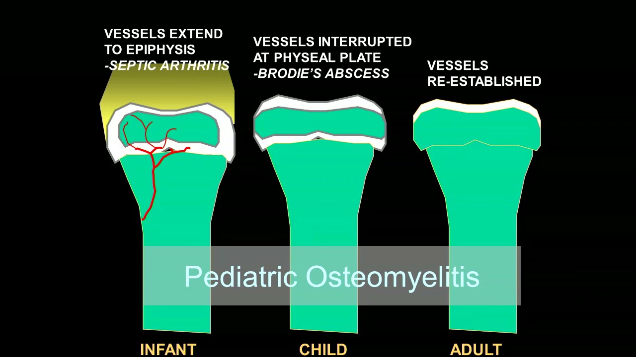 Imaging osteomyelitis, acute and chronic