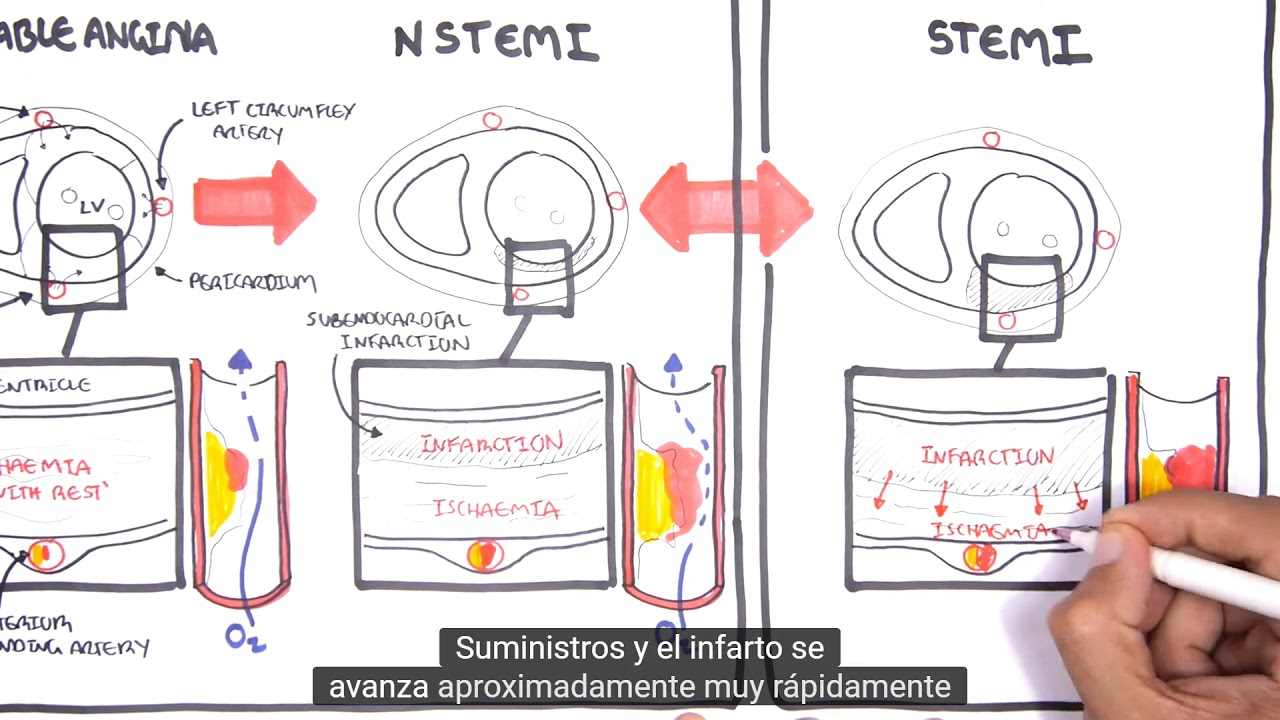 S&iacute;ndrome Coronario Agudo SCACEST SCASEST