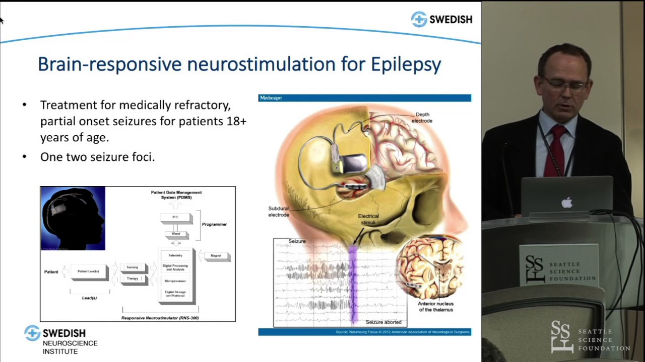 Responsive Neurostimulation for Epilepsy by Ryder Gwinn, M.D.