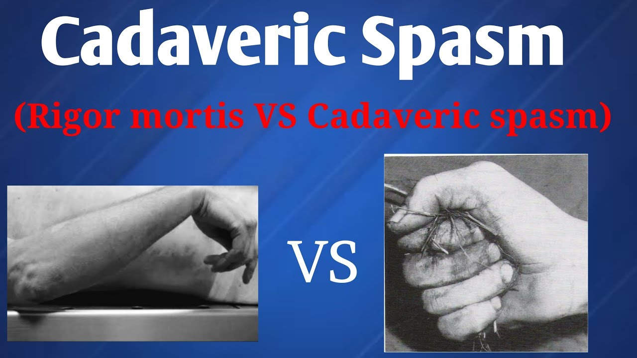 Cadaveric spasm | Difference between Rigor mortis & Cadaveric spasm