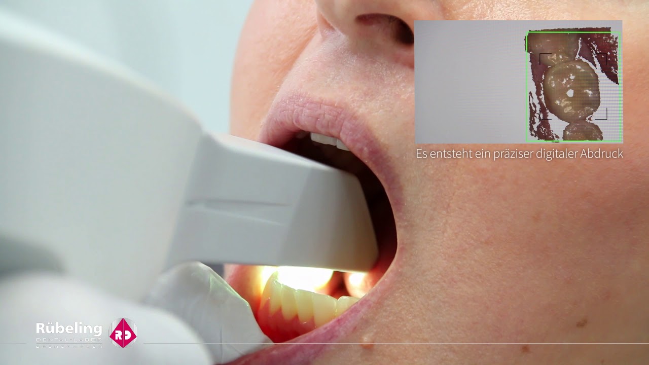 Digitale Abformung &ndash; Intraoralscan