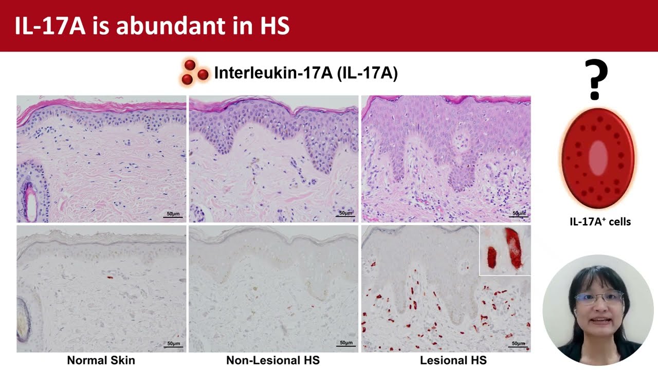 IL-17A+ mast cells in HS, C-B Chu&nbsp;et al.