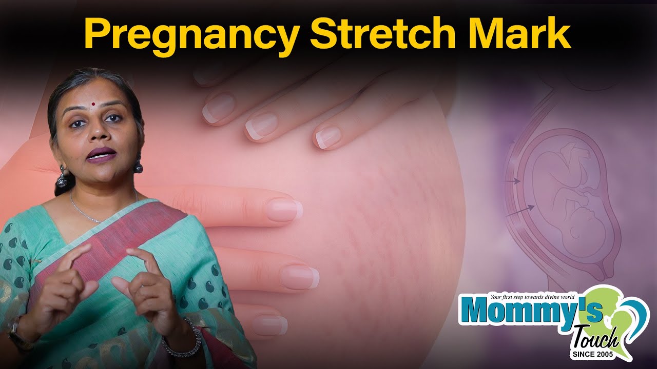 Pregnancy Stretch mark|| Mommy's Touch Garbhsanskar Institute || Dr Shital Lathiya
