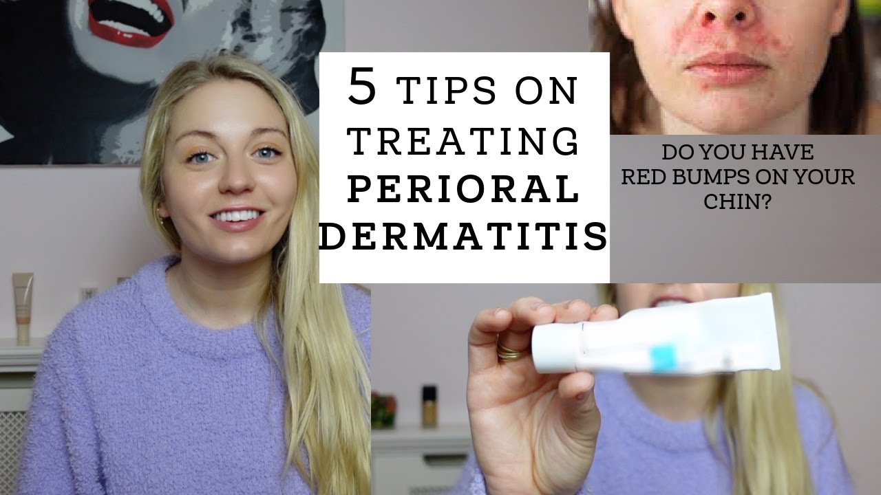 5 Tips on How I Treated my PERIORAL DERMATITIS