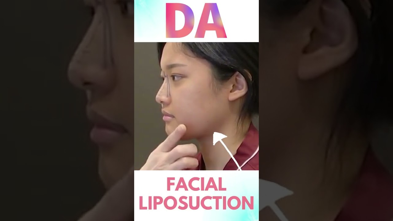 [Plastic Surgery in Korea] Rhinoplasty & facial contouring result from DA Plastic Surgery