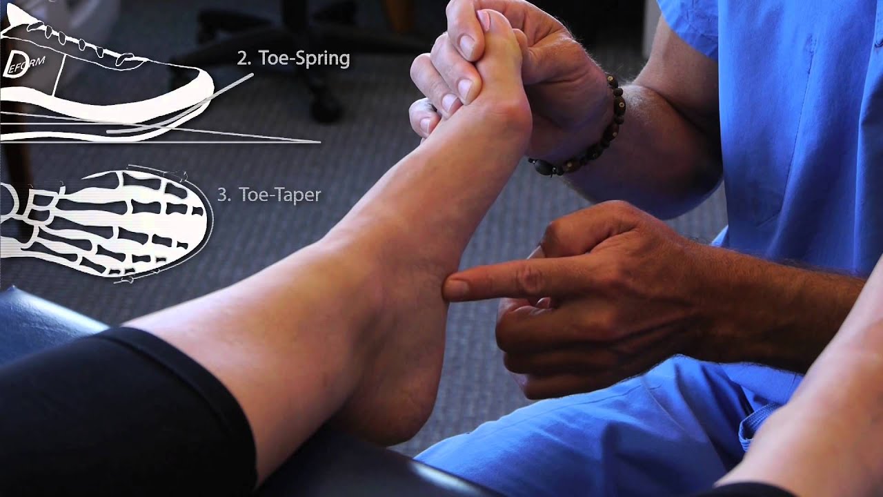 Spread Your Toes™ Series: Plantar Fasciosis (Fasciitis), Conservative Care vs. Conventional Care