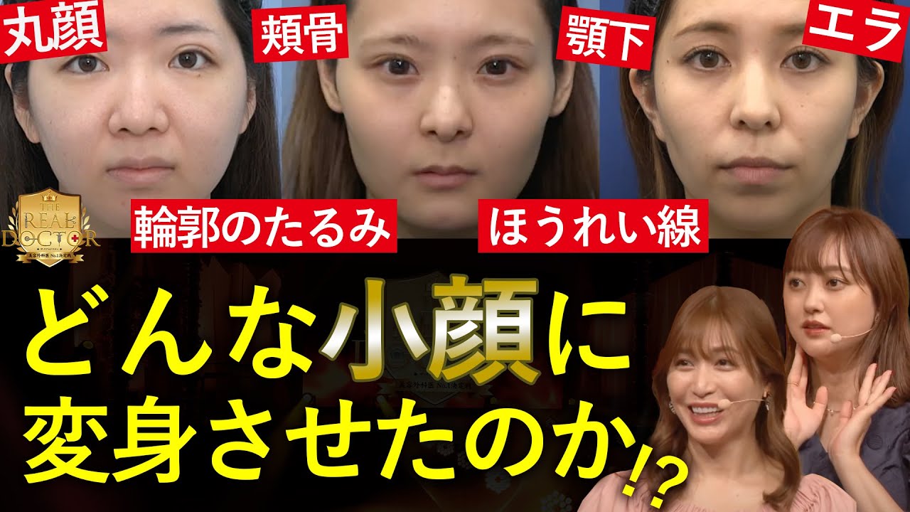 丸顔、頬骨、エラ、たるみなどのお悩みがある小顔になりたい女性たち。果たしてどんな小顔に変身したのか？骨切り・脂肪吸引なしでこの劇的な変化にきっとあなたも称賛する！リアルドクター美容外科医No,1決定戦