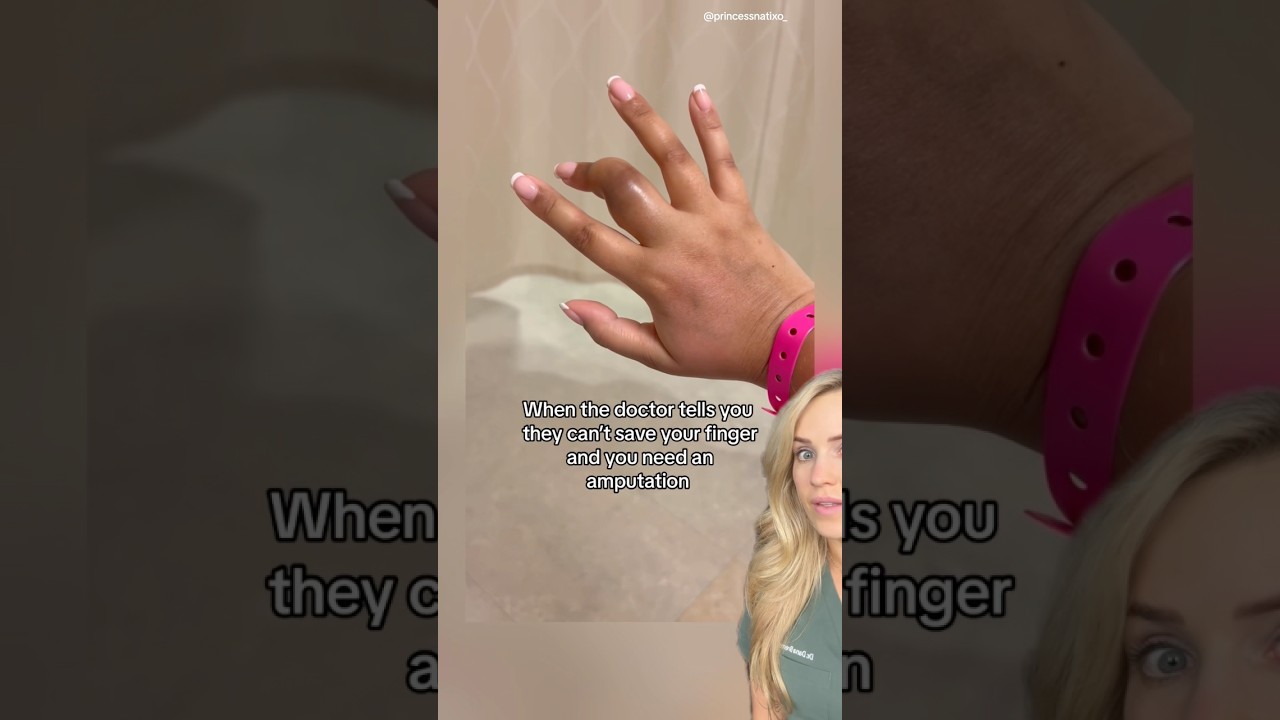 Doctor reacts: finger amputation?!