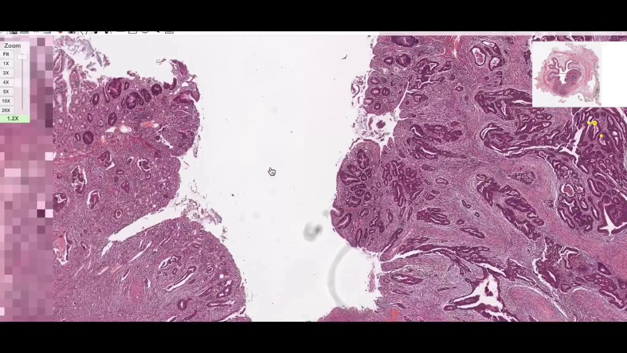 Adenocarcinoma - Basics #ranjithar #dams