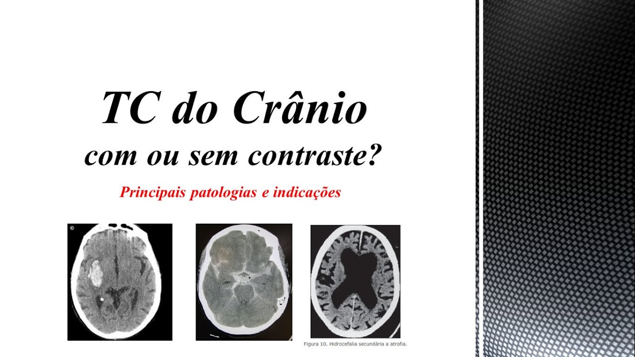 TC do Crânio - Indicações e Patologias