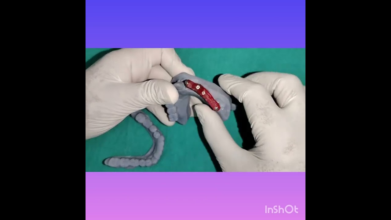 How to do jig trial in implant supported Fixed Partial denture