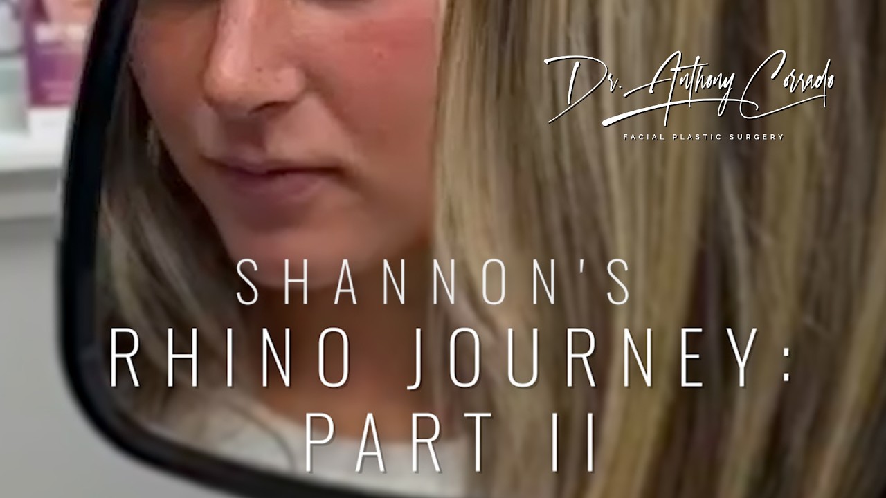 Shannon's Rhinoplasty Journey (Part 2) | Ecstatic 1-Week Reveal + 4-Month Results with Dr. Corrado