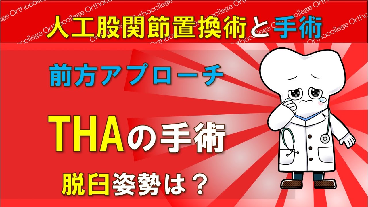 人工股関節置換術と前方アプローチ 脱臼姿勢は？ 【医師が解説】