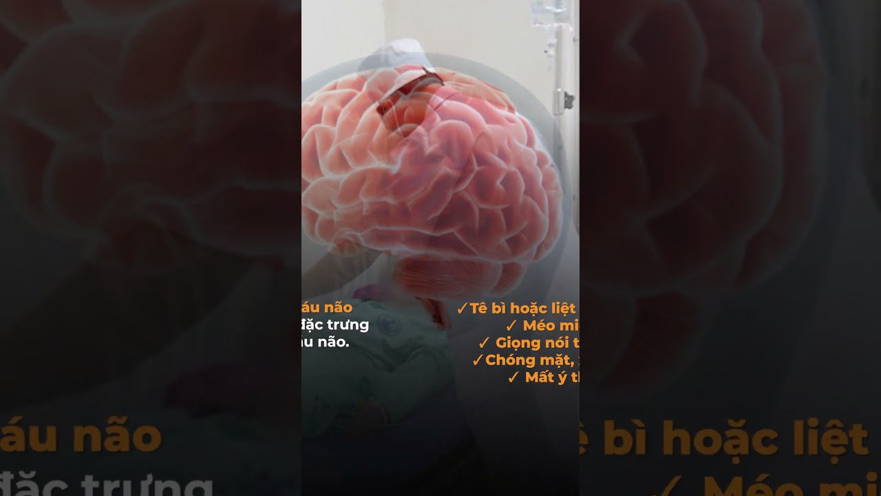 Dấu hiệu đột quỵ trước 1 tuần bạn nhất định phải biết