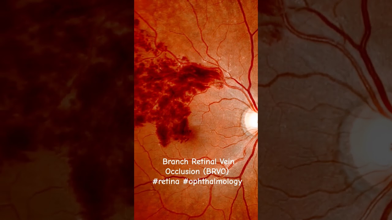 Branch Retinal Vein Occlusion (BRVO) #retina #ophthalmology #americanacademyofophthalmology