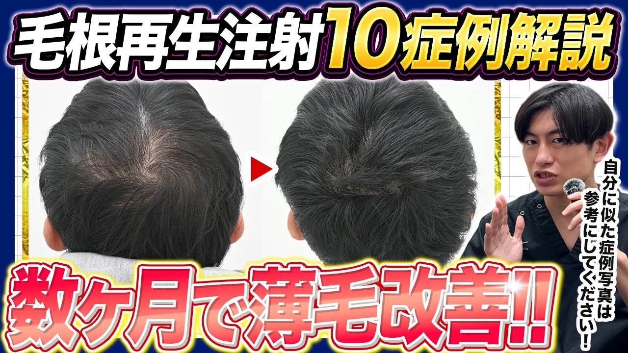 【医師解説】毛根再生注射でここまで変わる！AGA治療10症例を徹底紹介！