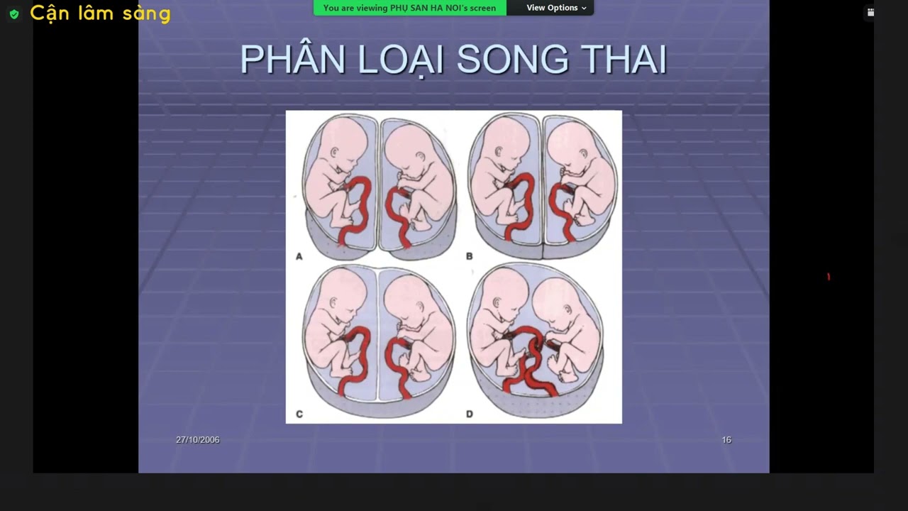SIÊU ÂM SONG THAI QUÝ I | THS. BS. NGUYỄN CẢNH CHƯƠNG