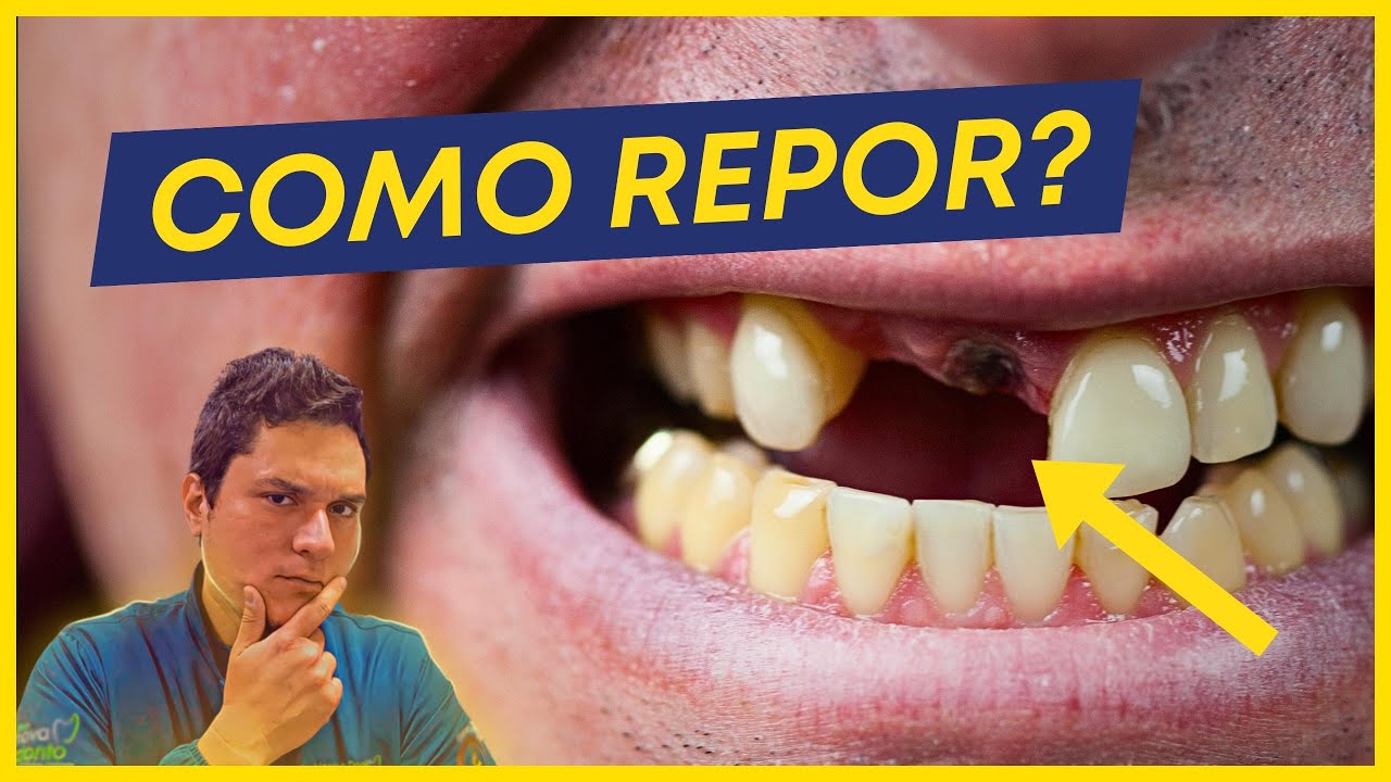 COMO REPOR DENTES PERDIDOS? (7 MELHORES ALTERNATIVAS).