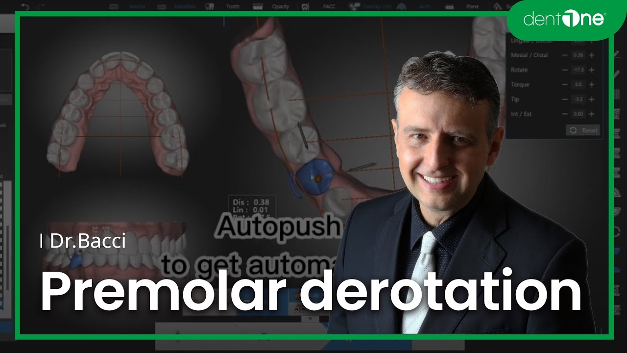 [Dr.BACCI] Premolar derotation