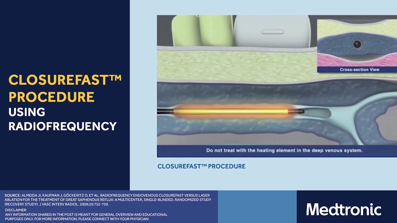 Treatment for varicose veins | ClosureFast™ procedure | Medtronic India