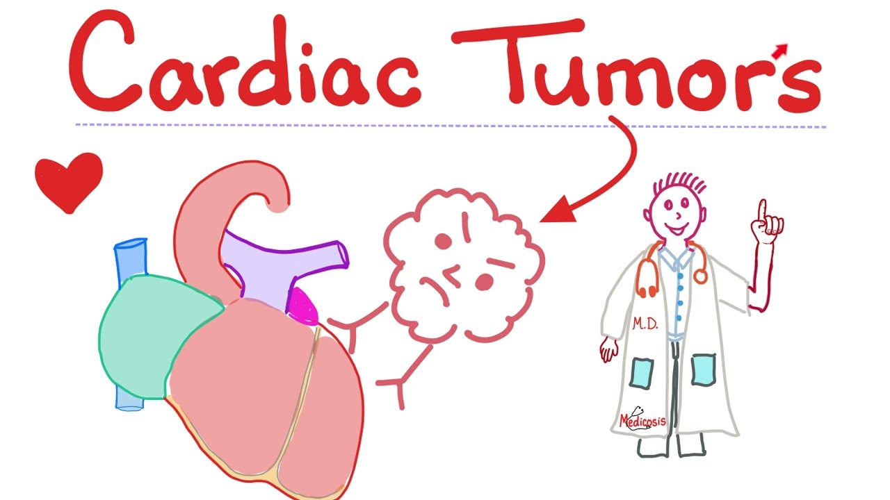 Heart Tumors - Myxoma, Rhabdomyoma, Leiomyosarcoma -  Cardiology Playlist
