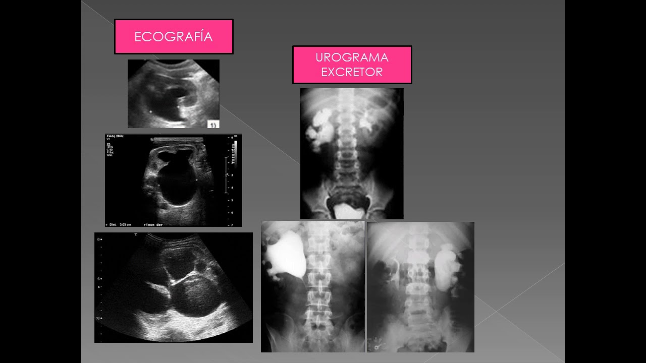 MALFORMACIONES CONGENITAS UROGENITALES