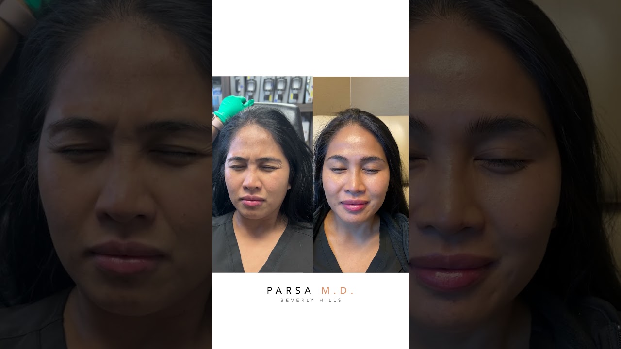 Xeomin Results for Crow's Feet ,11 Lines, and Forehead | Dr. Kami Parsa