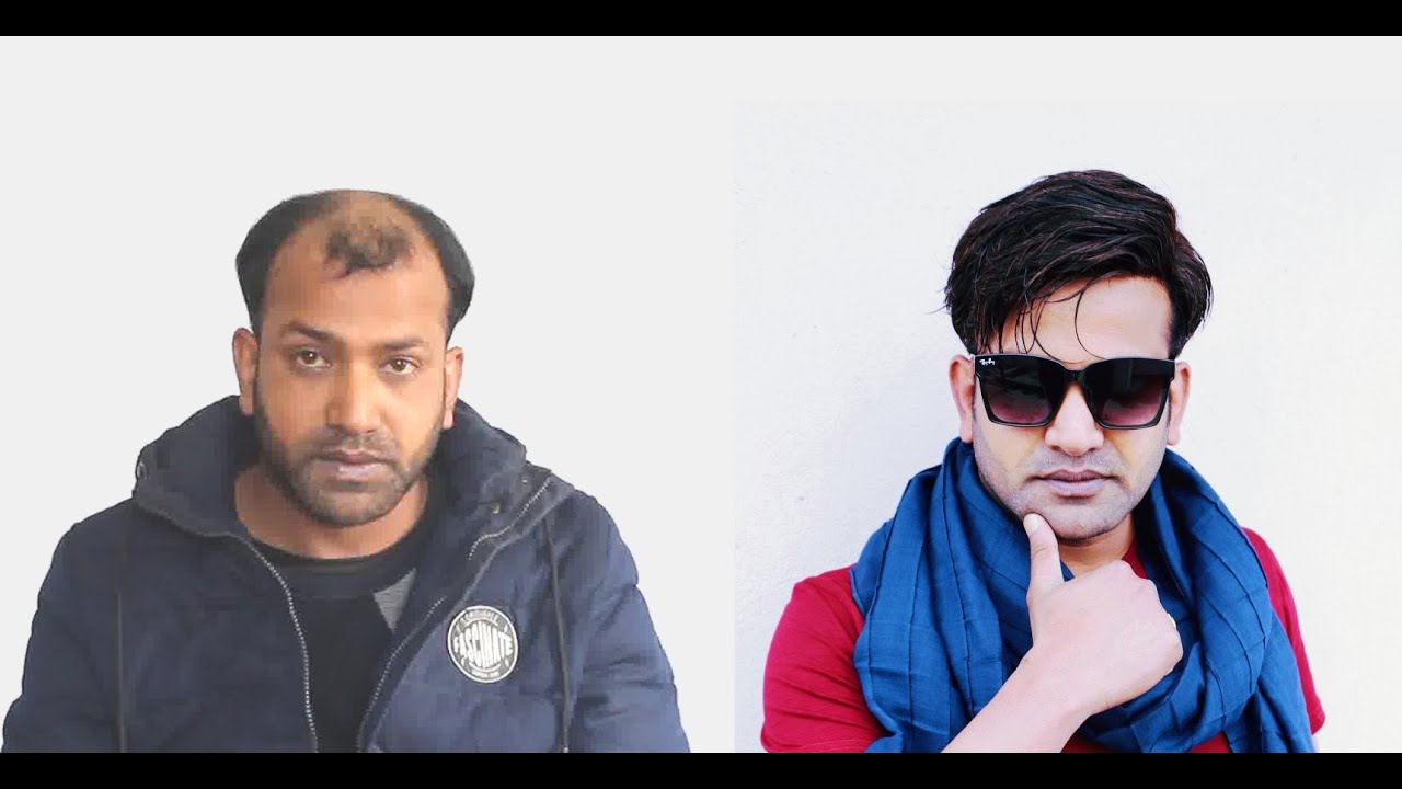 Non Surgical Hair Transplant- Hair Fixing - Hair Patch in Nepal | Lead Hair Replacement | 9851064228