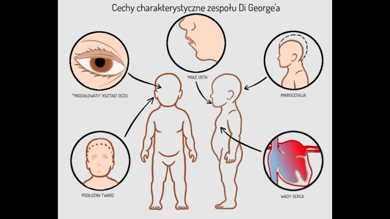 Zesp&oacute;ł diGeorge&rsquo;a - (3 pytania - Pediatria) - (cz.79)