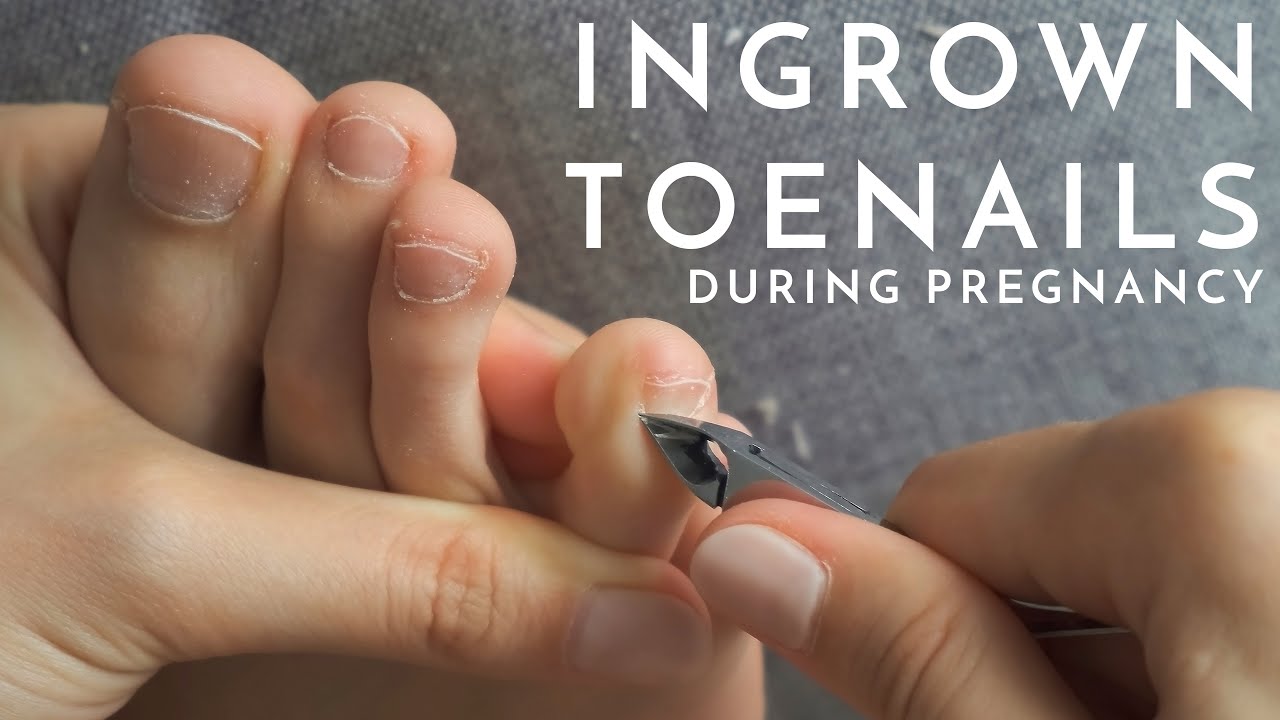 How to Manage Ingrown Toenails During Pregnancy - Podiatrist Georgina Tay, East Coast Podiatry
