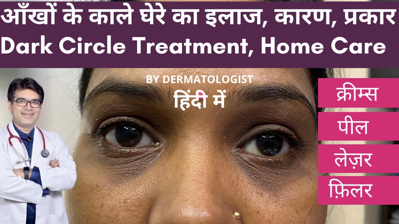 Dark Circles Treatment In Hindi | काले घेरे का इलाज | काले घेरे का इलाज कैसे होता है ।