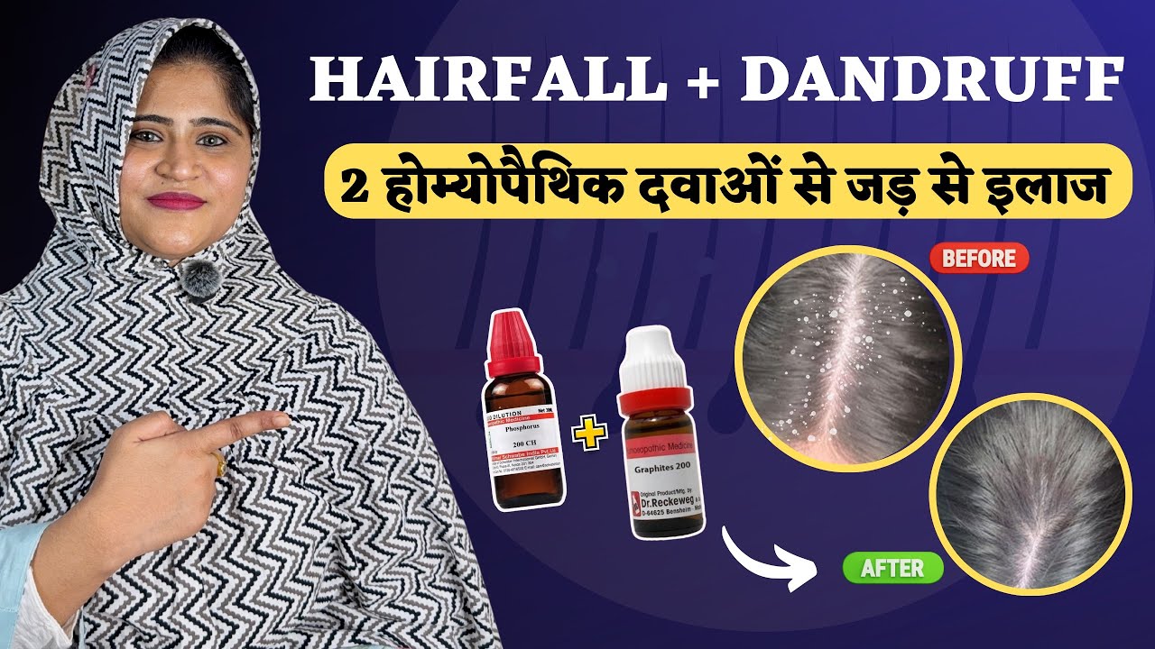 Hairfall और Dandruff दोनों का जड़ से इलाज || 2 Best Homeopathic Medicines for 100% Results