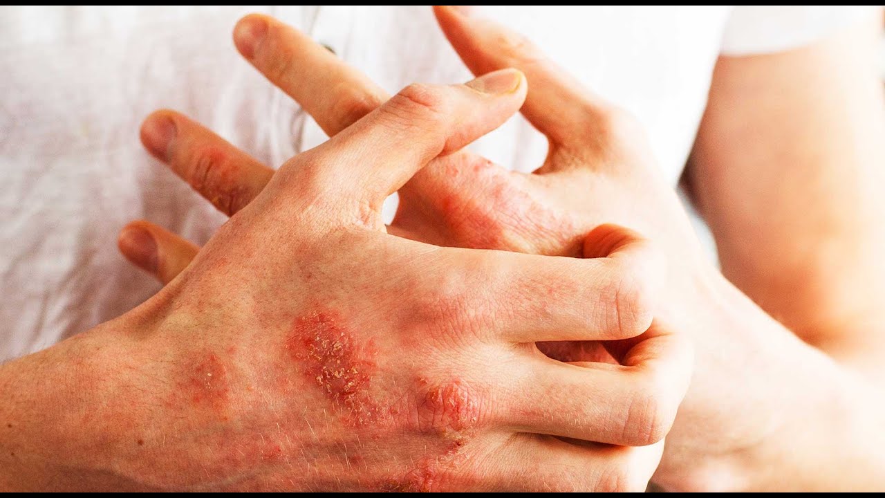 Psoriasis, Psoriasis-Arthritis und Sport?