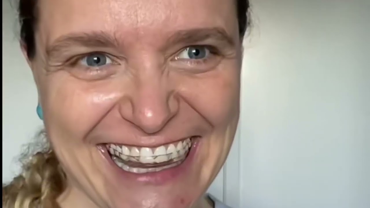 Novela do invisalign - capítulos 1, 2, 3, 4, 5, 6