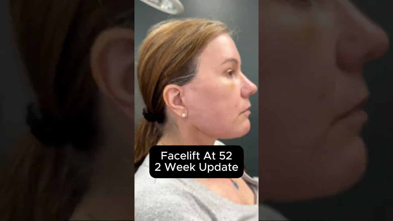 Подтяжка лица в 52 года — обновление через 2 недели 
