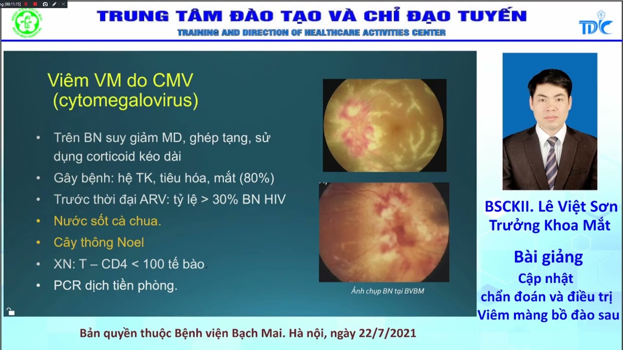 Cập nhật chẩn đoán và điều trị Viêm màng bồ đào sau