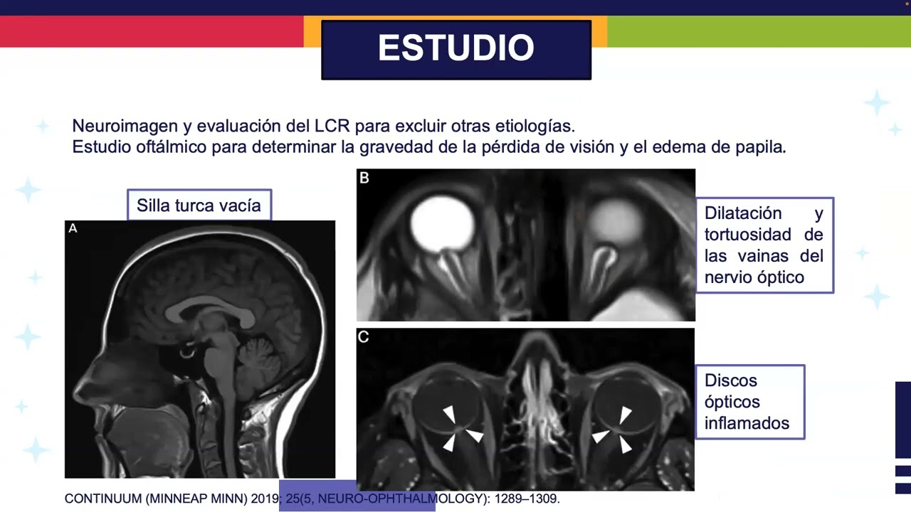 Actualización en Hipertensión Intracraneal Idiopática
