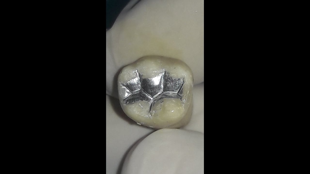 Amalgm restoration for mandibular first molar