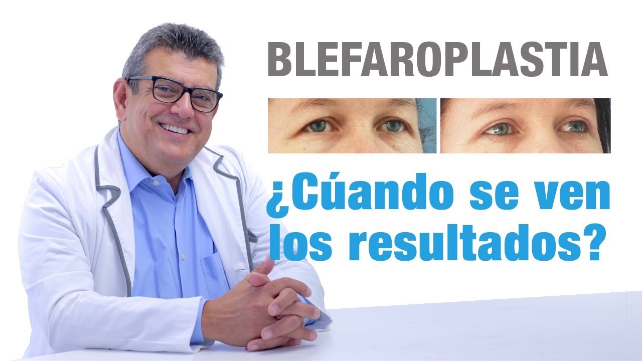 Cu&aacute;ndo se ven los resultados de la Blefaroplastia |  Cl&iacute;nicas Diego de Le&oacute;n